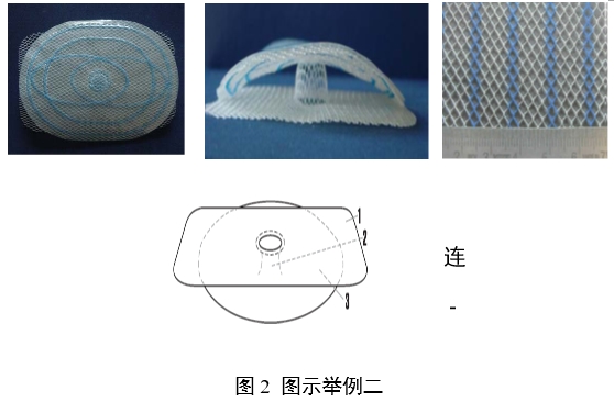 疝修補補片注冊審查指導(dǎo)原則(2023年修訂版)(2023年第9號)(圖5) 疝修補補片注冊審查指導(dǎo)原則(2023年修訂版)(2023年第9號)(圖5)