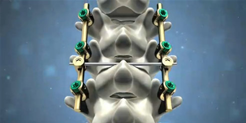 脊柱后路內(nèi)固定系統(tǒng)注冊技術(shù)審查指導原則(2016年第70號)(圖1) 脊柱后路內(nèi)固定系統(tǒng)注冊技術(shù)審查指導原則(2016年第70號)(圖1)